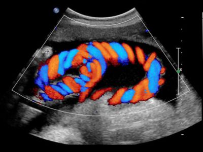 Color Doppler