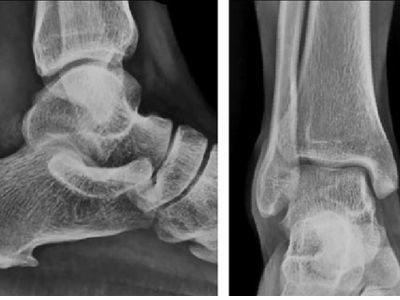 Ankle Joint AP/LAT