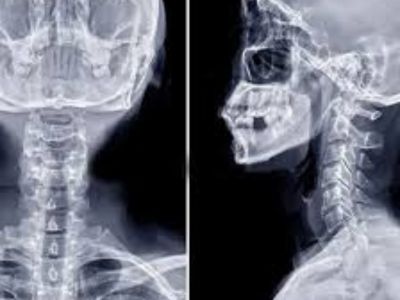 Cervical Spine AP/LAT