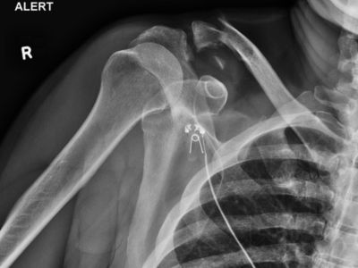 Shoulder Joint AP/Abduction