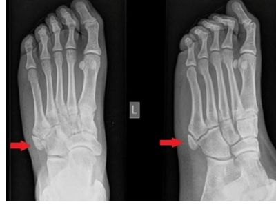 Foot AP/Oblique