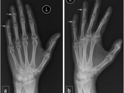 Wrist Joint AP/LAT