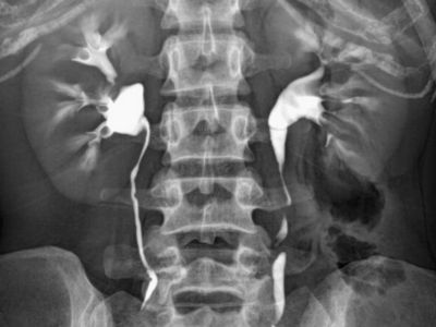Intravenous Pyelogram (IVP)